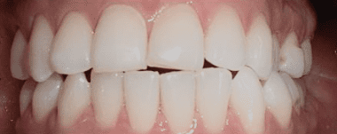 Adults patient 1 teeth before orthodontic treatment