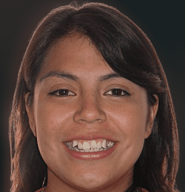 Adults patient 2 smile before orthodontic treatment