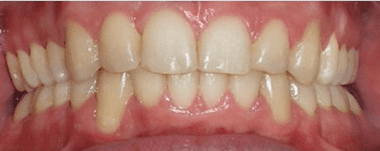 Adults patient 3 teeth after orthodontic treatment