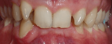 Adults patient 3 teeth before orthodontic treatment