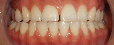 Adults patient 4 teeth before orthodontic treatment