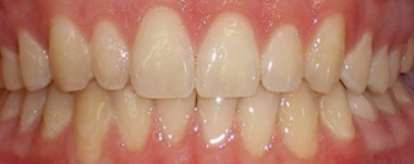 Kids patient 1 teeth after orthodontic treatment
