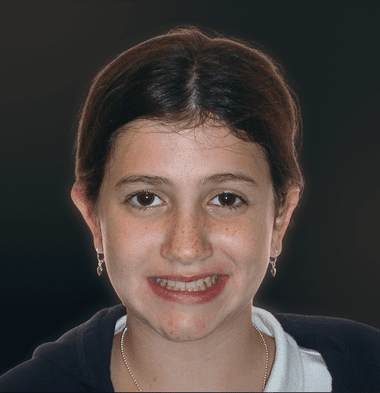 Kids patient 2 smile after orthodontic treatment