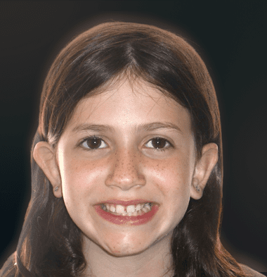 Kids patient 2 smile before orthodontic treatment