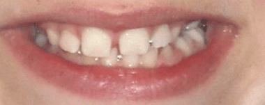 Kids patient 2 teeth before orthodontic treatment
