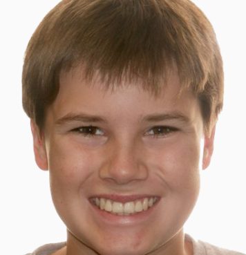 Kids patient 3 smile after orthodontic treatment