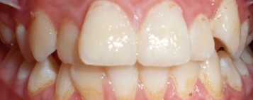 Kids patient 3 teeth before orthodontic treatment