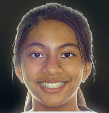Kids patient 4 smile after orthodontic treatment