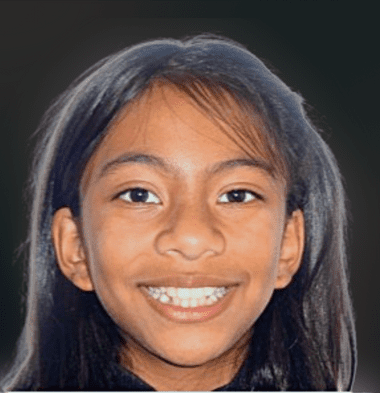Kids patient 4 smile before orthodontic treatment
