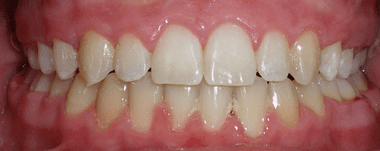 Kids patient 5 teeth after orthodontic treatment