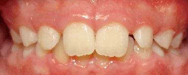 Kids patient 5 teeth before orthodontic treatment