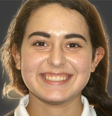 Teens patient 1 smile after orthodontic treatment