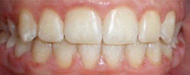 Teens patient 1 teeth before orthodontic treatment