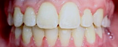 Teens patient 2 teeth after orthodontic treatment