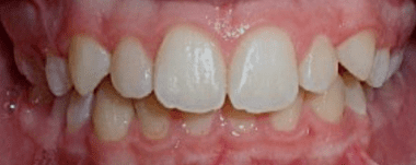 Teens patient 2 teeth before orthodontic treatment