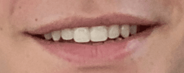 Teens patient 3 teeth after orthodontic treatment