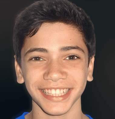 Teens patient 3 smile before orthodontic treatment