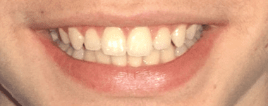 Teens patient 3 teeth before orthodontic treatment