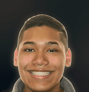 Teens patient 4 smile after orthodontic treatment