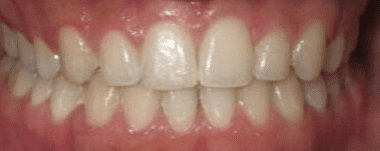 Teens patient 4 teeth after orthodontic treatment