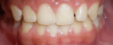 Teens patient 4 teeth before orthodontic treatment
