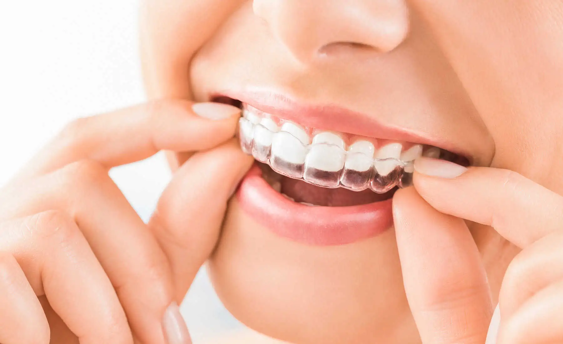 Invisalign Treatment Background
